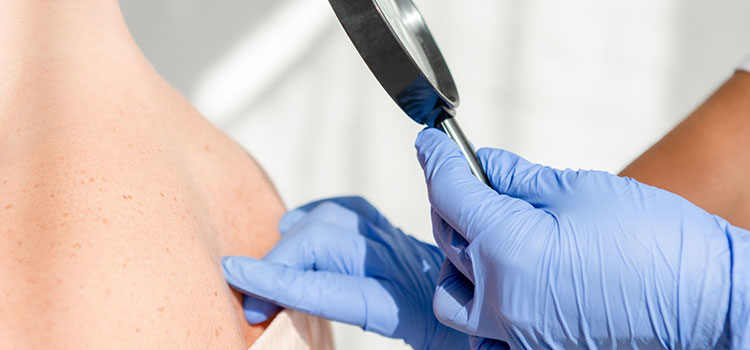 radiotalasno uklanjanje fibroma